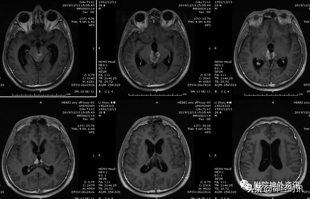 松果体占位怎样治疗,松果体区占位看什么科室