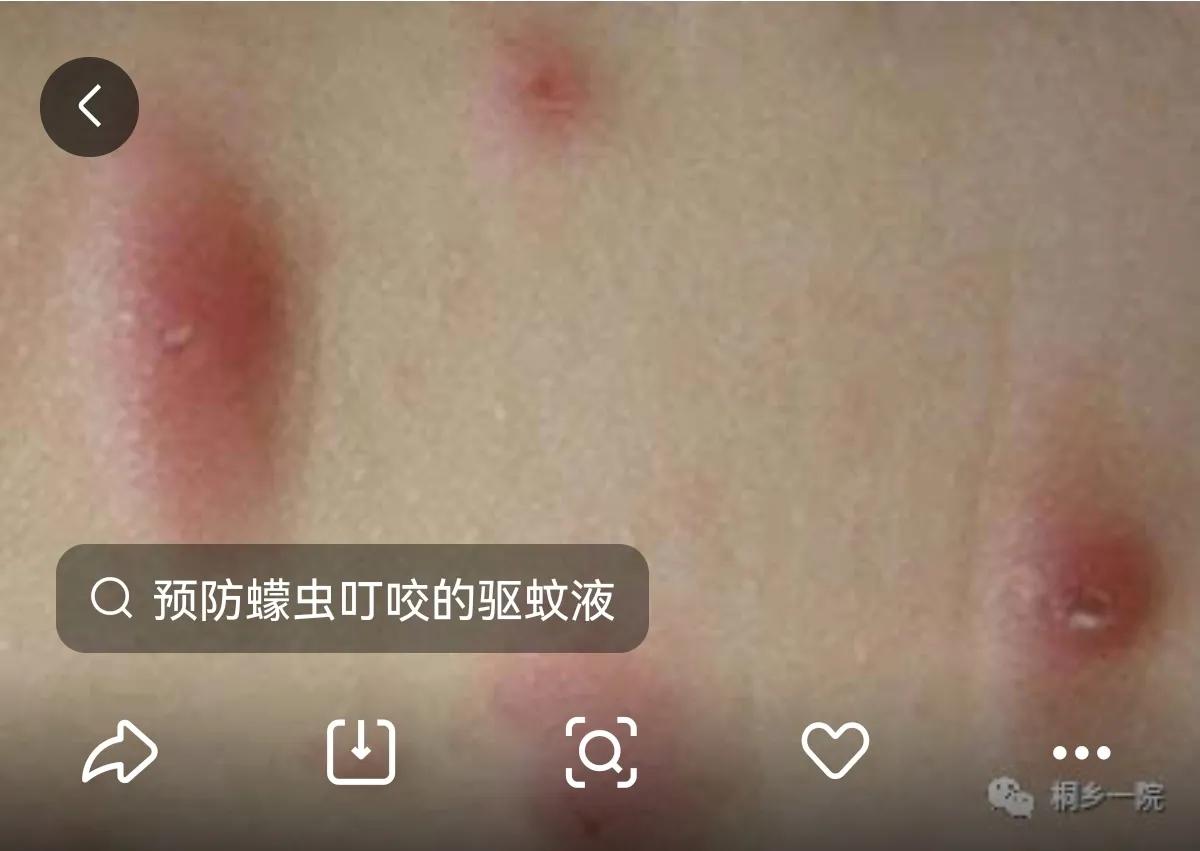 被墨蚊咬了身上全是小红点,被墨蚊子咬了怎样治疗