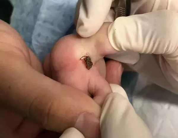 孩子脚上肿了一个包是怎么回事,孩子脚上起了个疙瘩后来就肿了