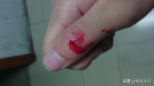 为什么手指划破止不住血,手指划破为什么止不住血