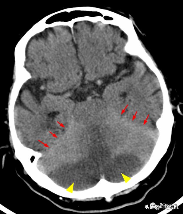 蛛血的临床表现,蛛血ct表现