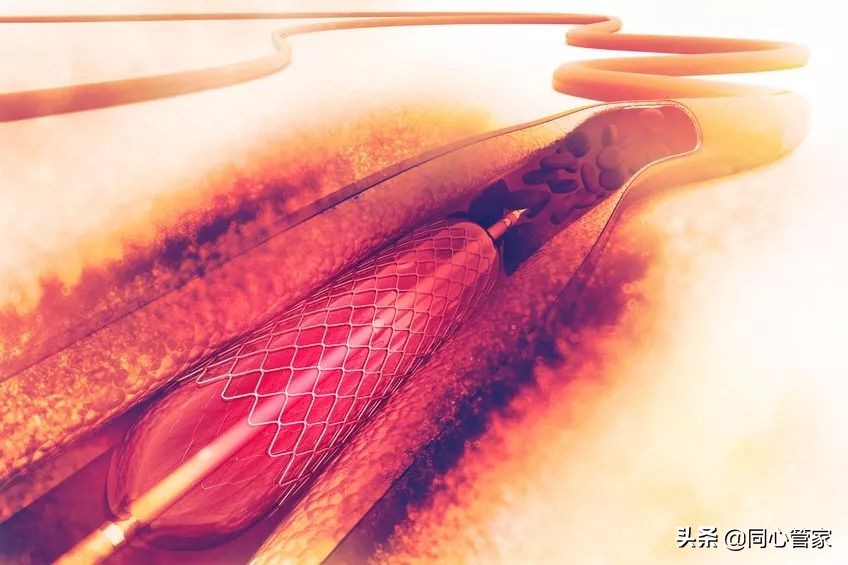 血管变脆能做支架吗,什么导致血管变脆不能下支架