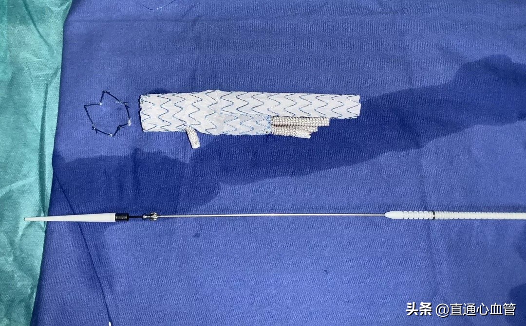 腔内“八爪鱼技术”治疗胸腹主动脉瘤！上海仁济医院血管外科叶猛团队自制“触角”完成高难度腔内隔绝术