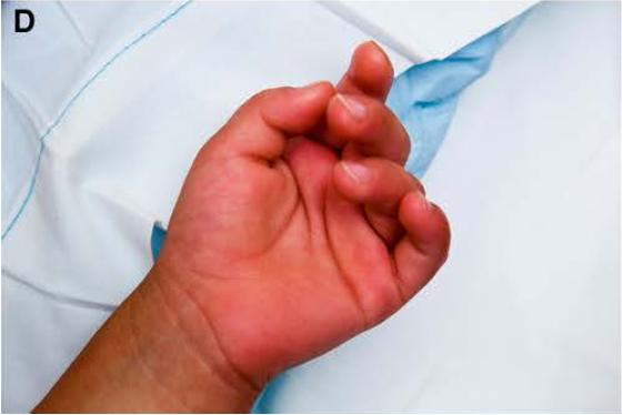 给儿童带来相对长时间发热的「川崎病」该如何治疗？