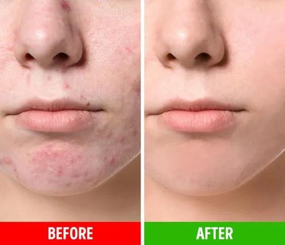 大红脸舒缓喷雾,修复大红脸喷雾