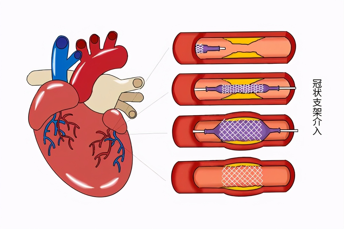 冠心病支架后又复发怎么办,冠心病支架后一年发现心衰