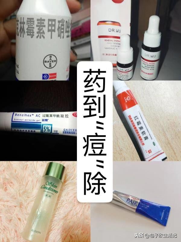 祛痘大作战,祛痘大作战最有效的方法