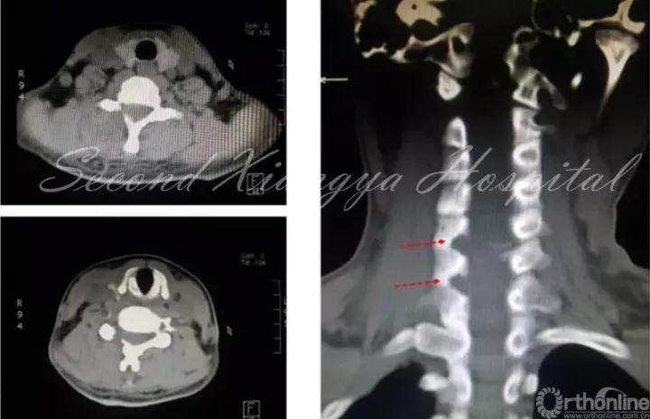 经皮腰椎间盘切除术有何优缺点,什么是经皮内镜腰椎手术