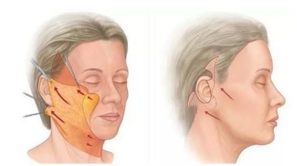 除皱方法大揭秘顺利抚平皱纹,除皱抗皱有什么好的方法