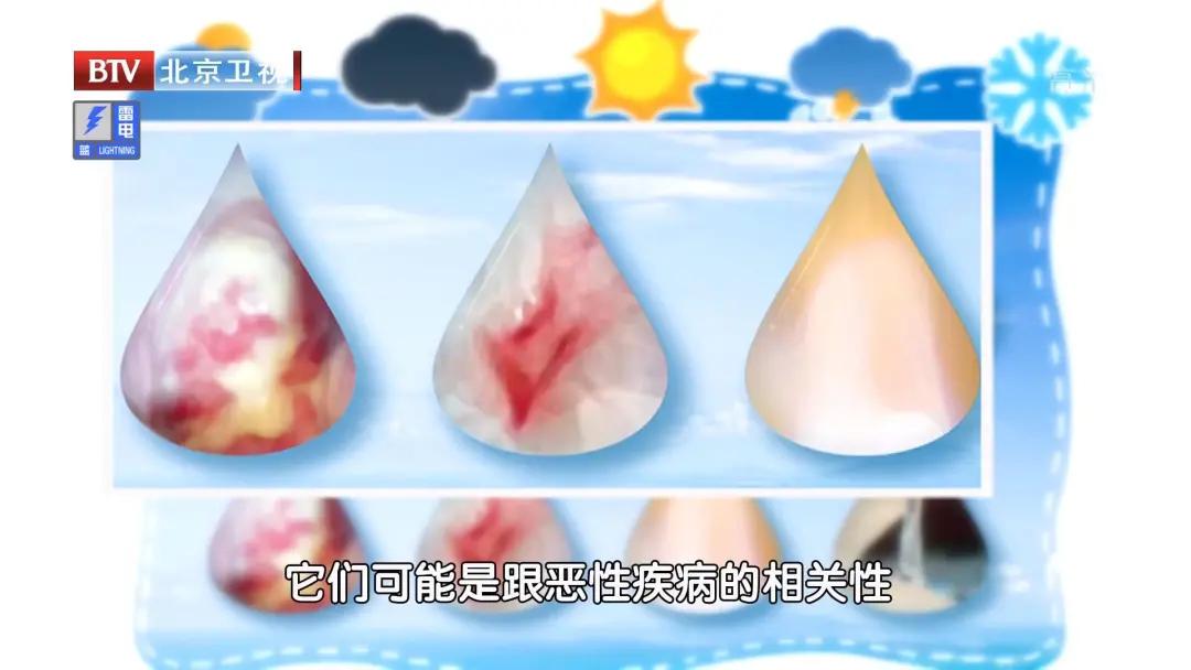 白带异常妇科疾病案例,白带异常就是妇科病前兆