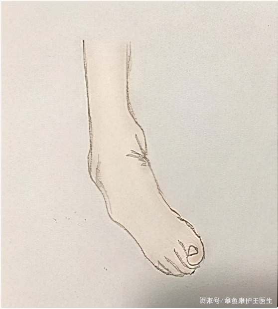 脑梗足外翻走路恢复方法,脑出血后足内翻怎么锻炼好得快