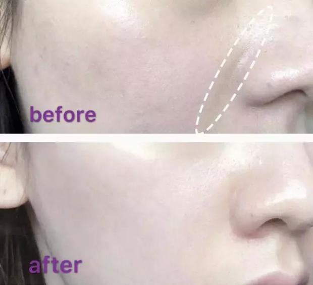 硬刚女皇龙妈也扛不住法令纹，2条沟壑让人心疼，贴一贴就消了