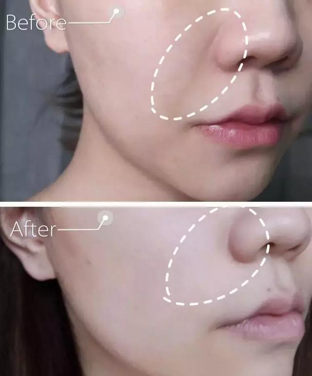 硬刚女皇龙妈也扛不住法令纹，2条沟壑让人心疼，贴一贴就消了