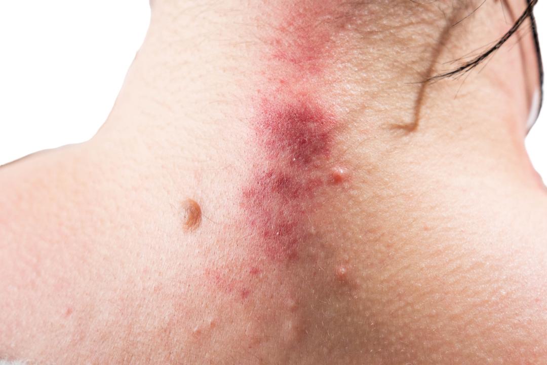 出痧有黑紫色泡怎么回事,出痧有痘是怎么回事