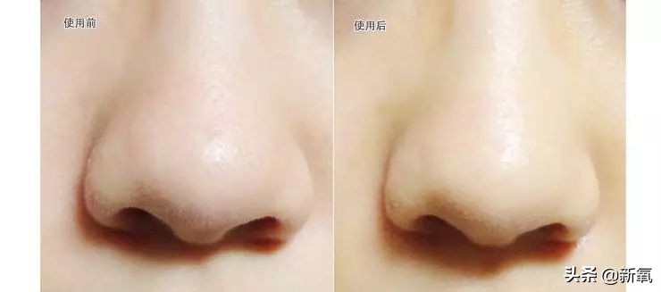 去黑头最有效的方法一个月见效,别挤了教你去黑头的正确方法