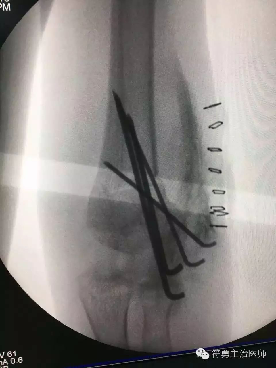 手臂肘内翻的手术效果,胳膊肘内翻矫正手术28年费用