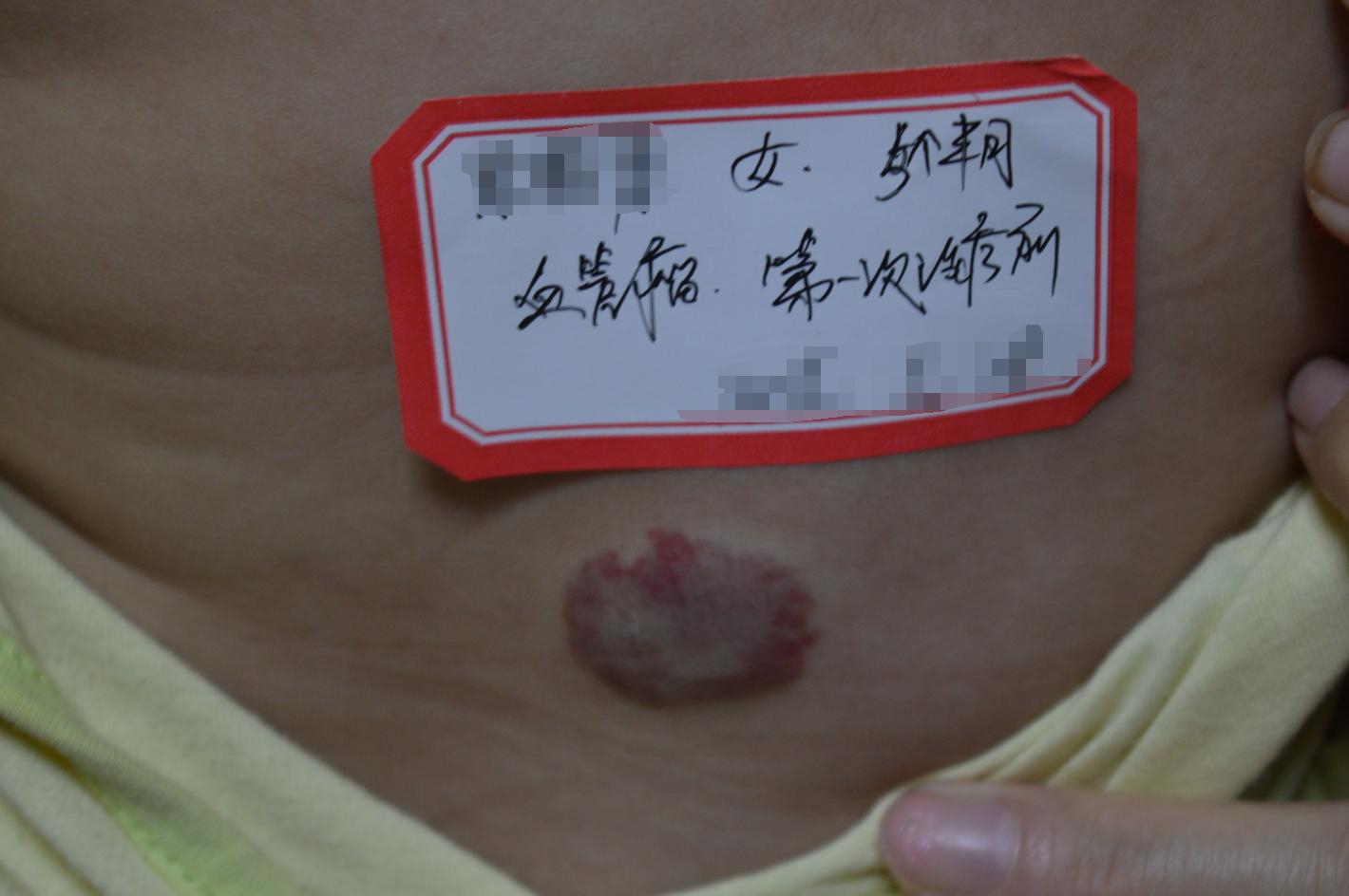 海绵状血管瘤中药治疗方法,小孩血管瘤先天不消退型