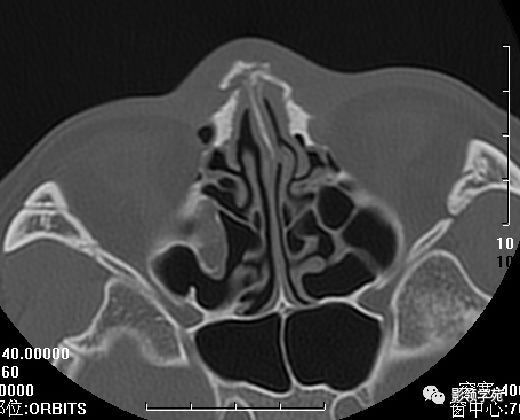 鼻骨骨折的检查方法,鼻骨骨折影像学表现