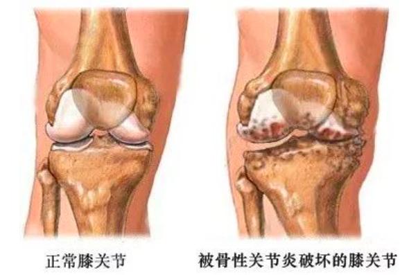 o型腿膝外侧关节疼痛,o型腿膝盖疼最好锻炼方法