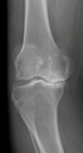 膝关节阶梯治疗ppt,膝关节骨性关节炎阶梯化治疗