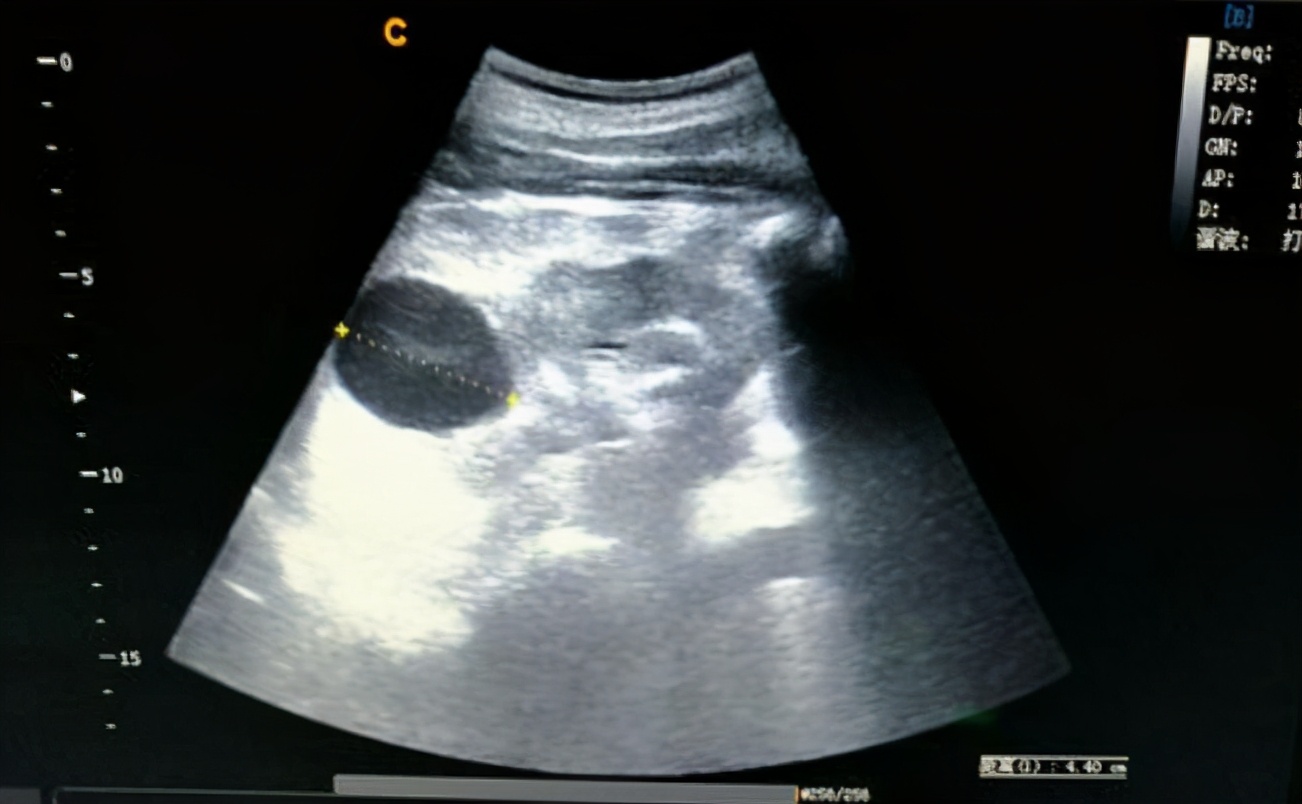 肾囊肿无创手术治疗全过程,发现肾囊肿吃什么药消掉