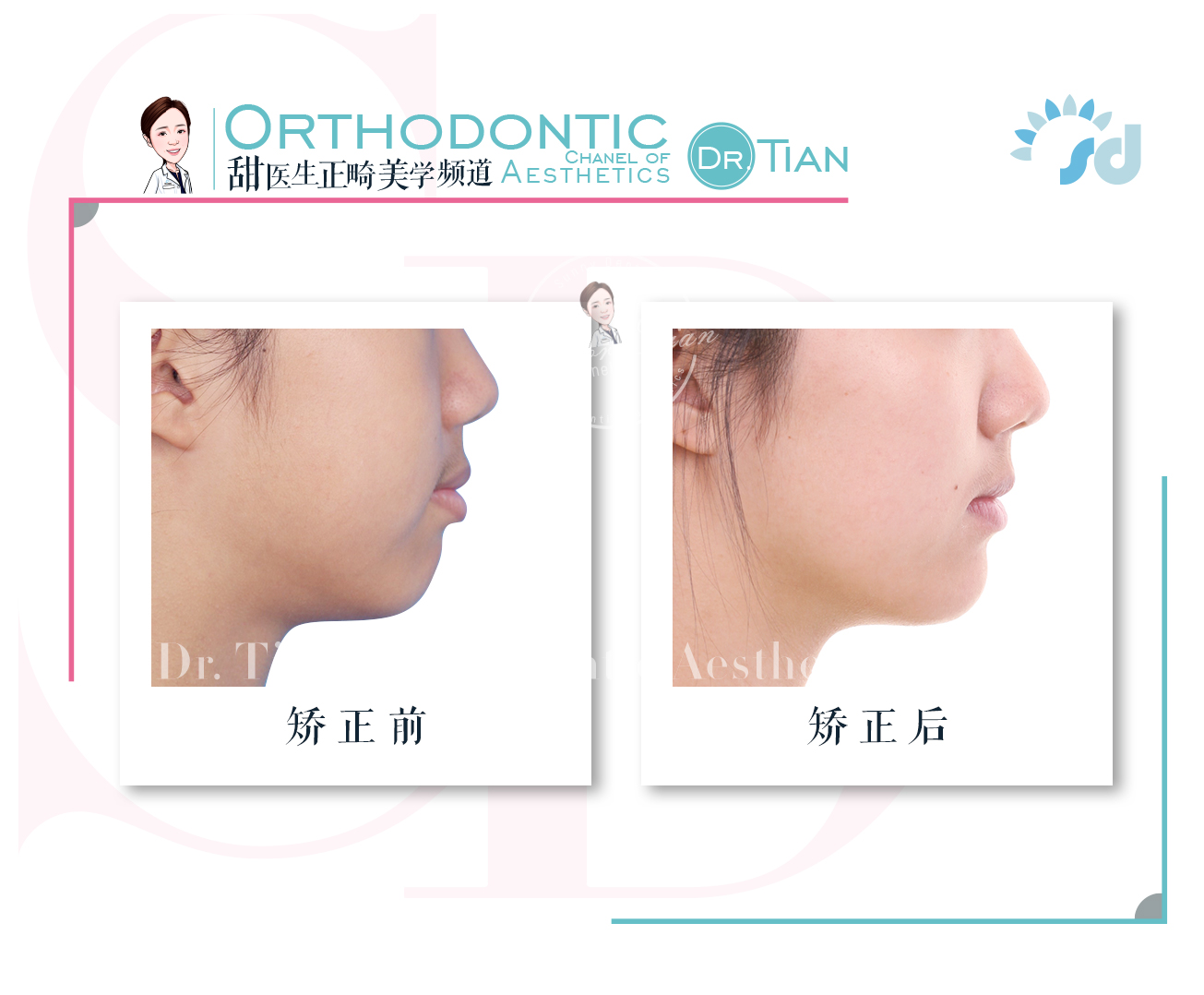 西安哪里有做牙齿矫正,在西安哪里可以做牙齿矫正