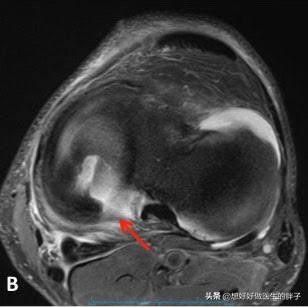 怎么走路才能缓解膝盖的疼痛,走路多了膝盖疼怎么康复锻炼