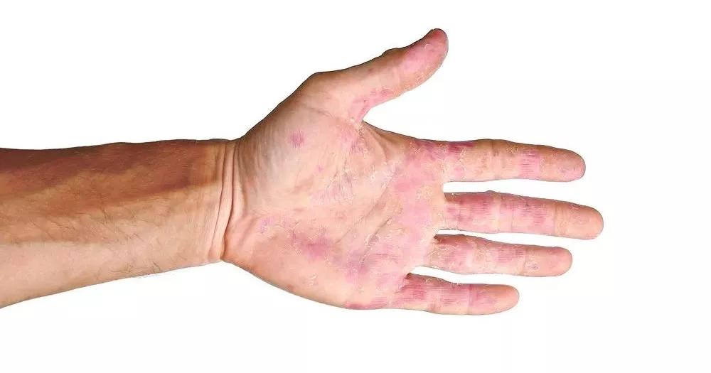 肝癌来临之前的三个预兆眼睛,肝癌来临前的5种信号