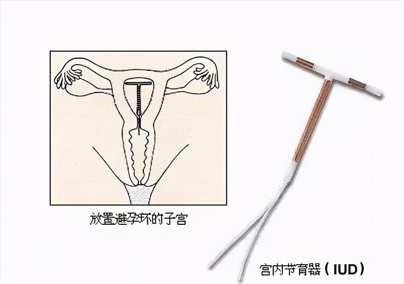 避孕上环需要啥手续,避孕的方式有很多为什么要上环