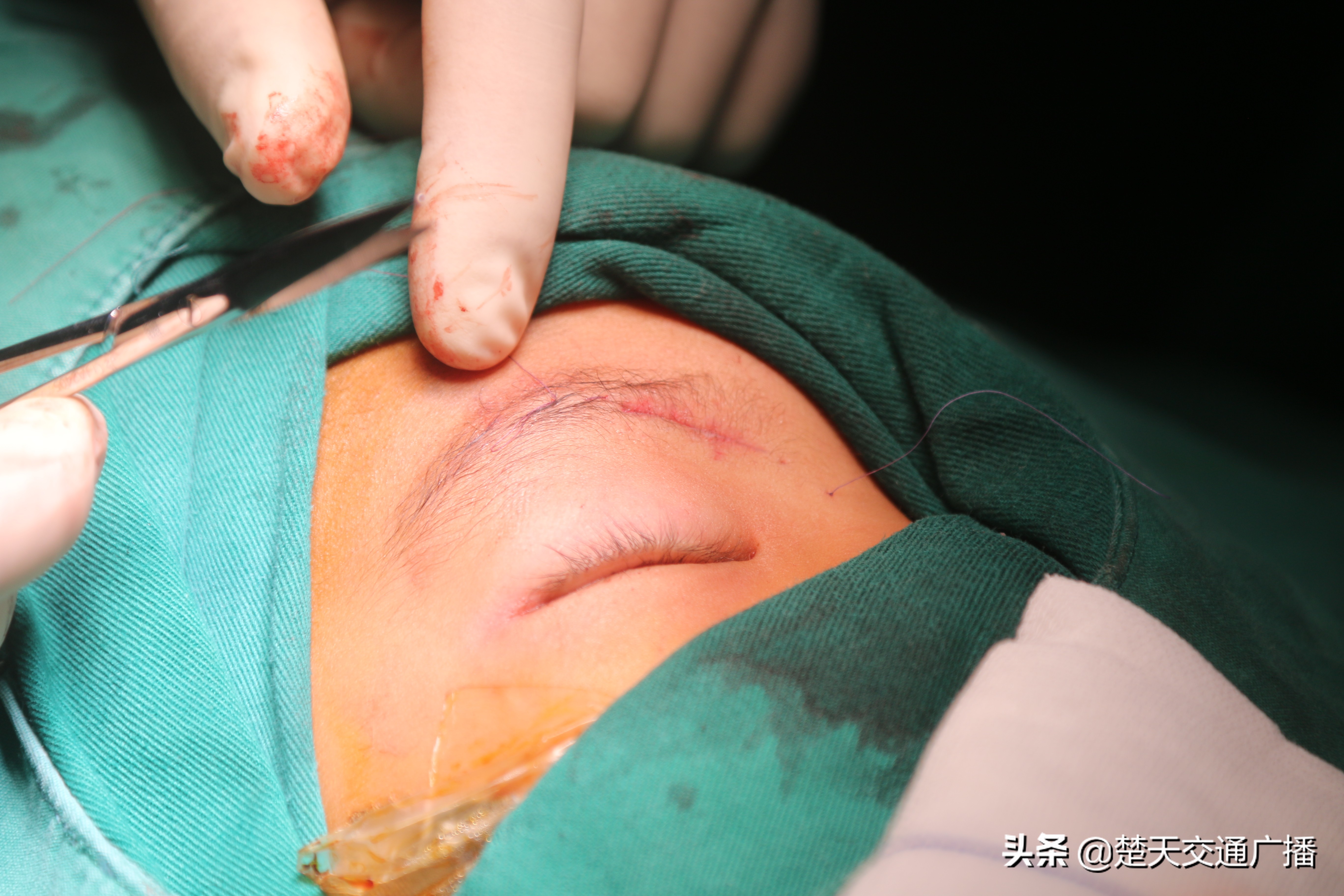 小孩的眼睛有肿瘤是什么原因,小孩脑袋长肿瘤导致眼睛模糊