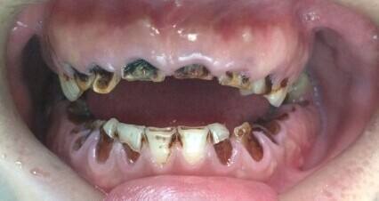 最先进的牙齿纠正,成年人不能忽略的22个牙齿问题