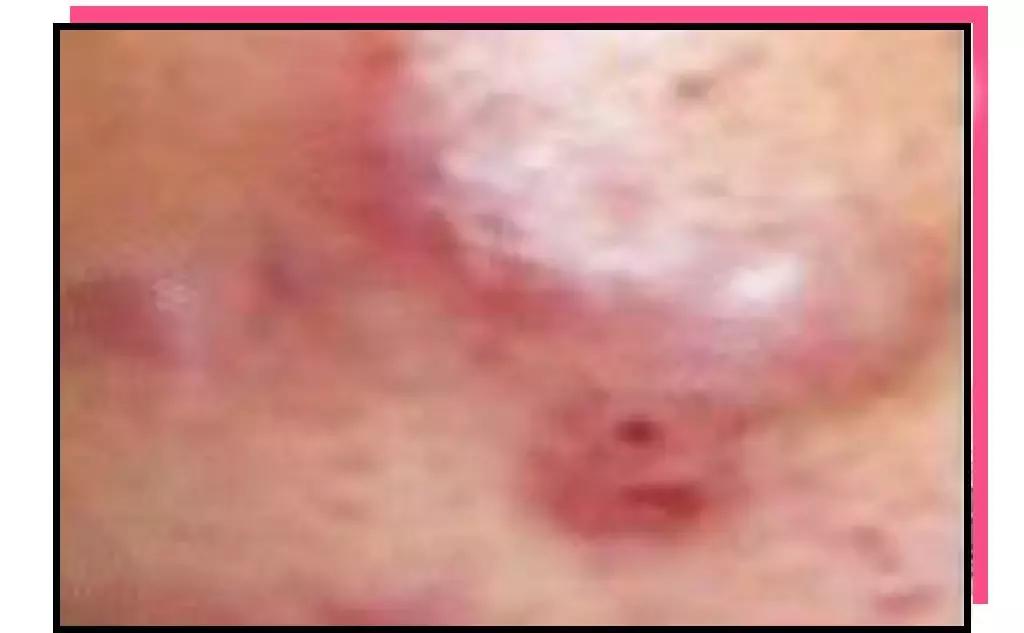 痘肌调理真实案例,痘肌10年了怎么修复