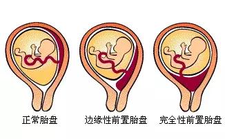 前置胎盘是怎么回事？到底有多危险？