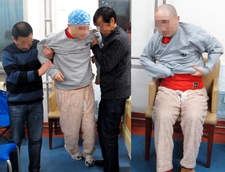 脑受伤开颅手术昏迷,开颅手术后20天发生脑积水引流