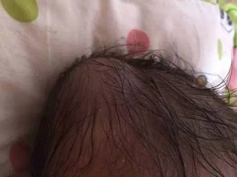 头皮血肿半年会变成瘤吗,产瘤和血肿的区别ppt