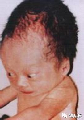 要是不打疫苗有事吗,不打疫苗对住院有影响么