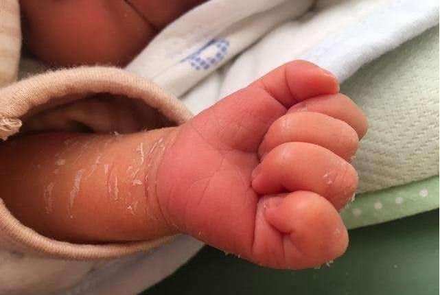 新生儿易受疾病侵扰的症状,儿童保健新生儿常见的生理现象