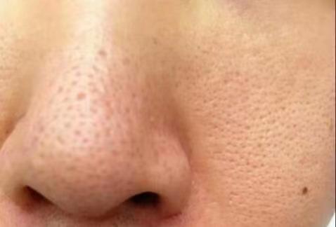 李佳琦推荐去黑头产品真的好用吗,吸黑头神器李佳琦推荐