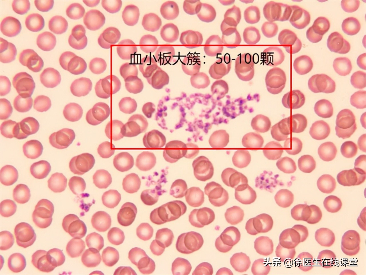 血粘度高吃脂必妥管用吗,血粘度偏高吃阿司匹林吃多久停药