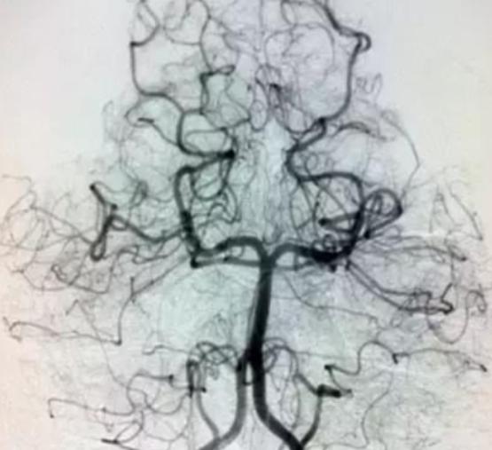 四肢麻木无力不听使唤怎么治,右边麻木无力怎么康复