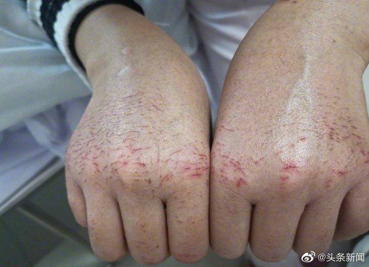 抗疫护手霜,手脱皮细菌感染用啥护手霜