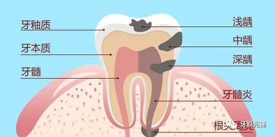 牙缝漏风很少塞牙,牙缝大吃饭塞牙吃什么好