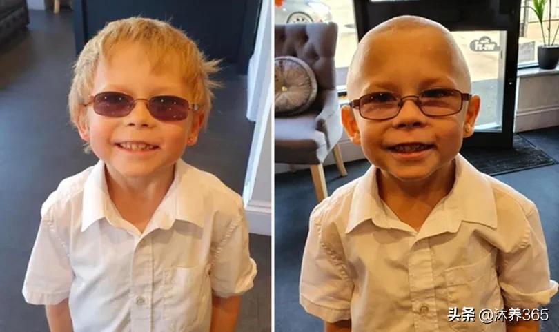 20岁发际线后移的原因,20岁越来越秃的发际线