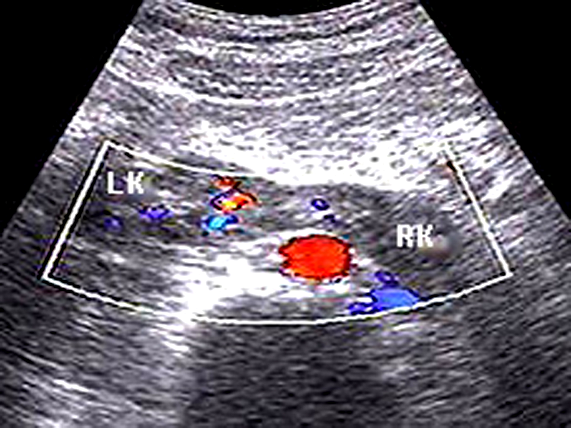 胎儿右肾发育不良是不是属于畸形,胎儿泌尿系统畸形超声表现
