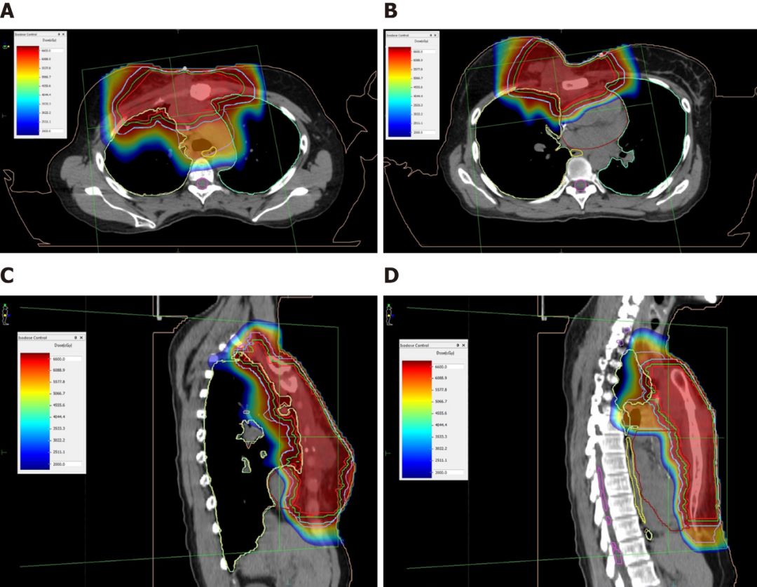 乳腺癌10年,十年乳腺癌患者
