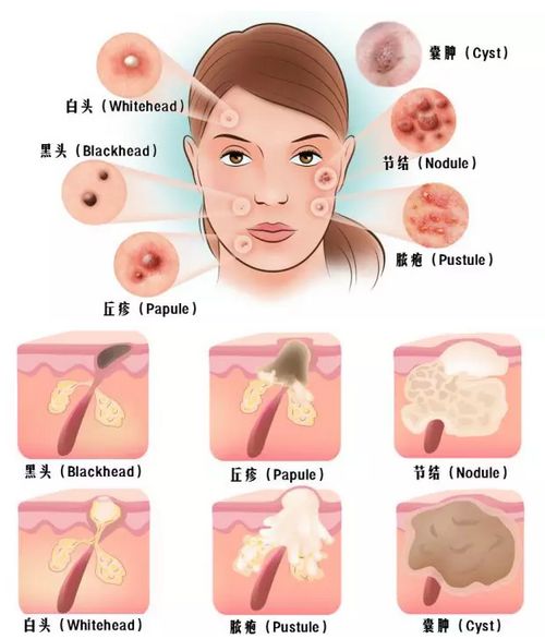 菌群问题,过敏与肠道菌群失调有关吗