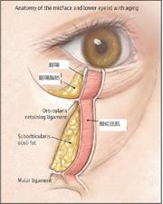 如何分清自己是哪种类型的眼袋,怎么看是哪种类型的眼袋