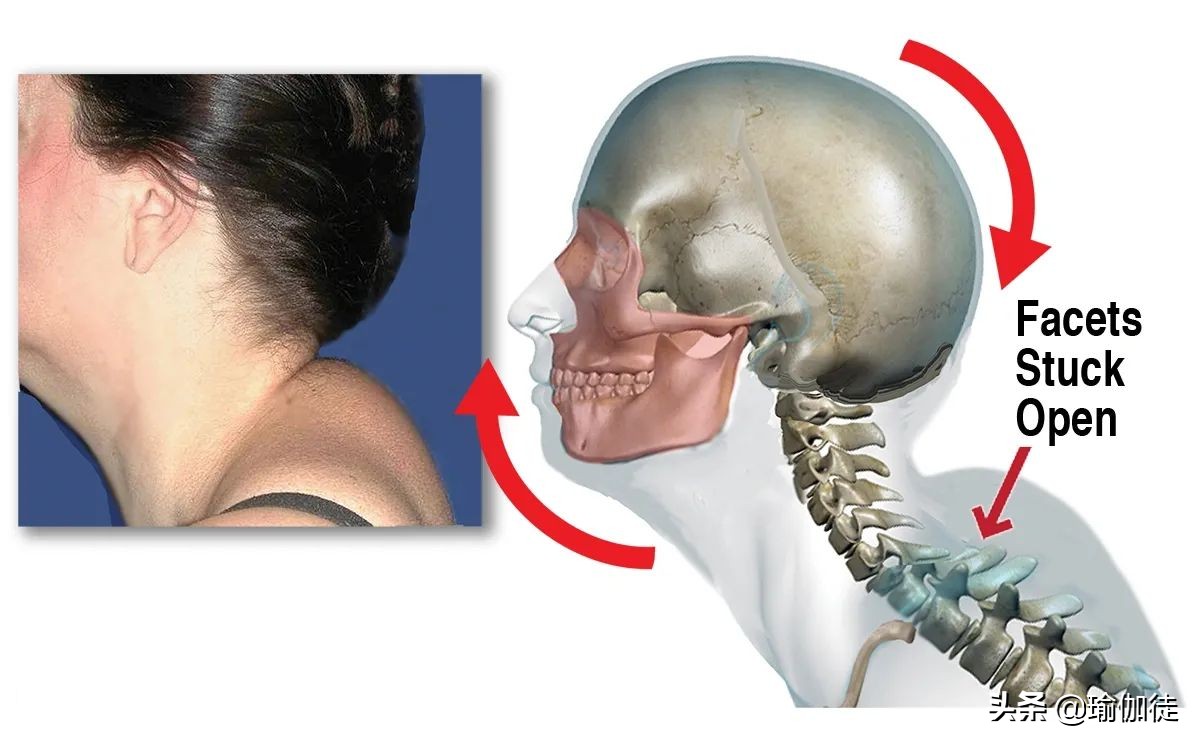 颈椎富贵包怎么消除最有效方法,怎样快速消除颈椎的富贵包