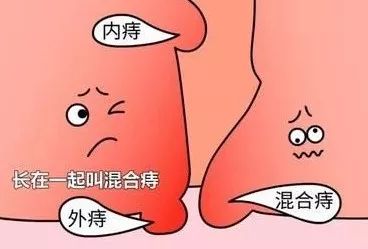 内外混合痔疮自己怎么分辨,怎么区分外痔疮类型