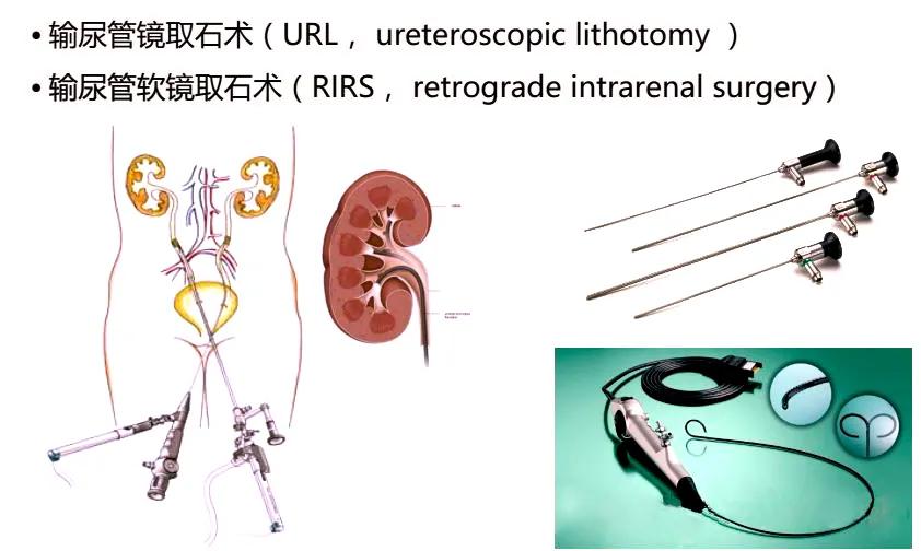 输尿管堵塞引起肾积水还能喝水吗,为什么喝水可以排出结石